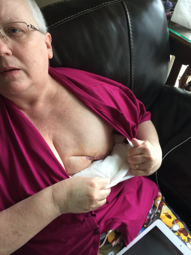 mastectomy scar