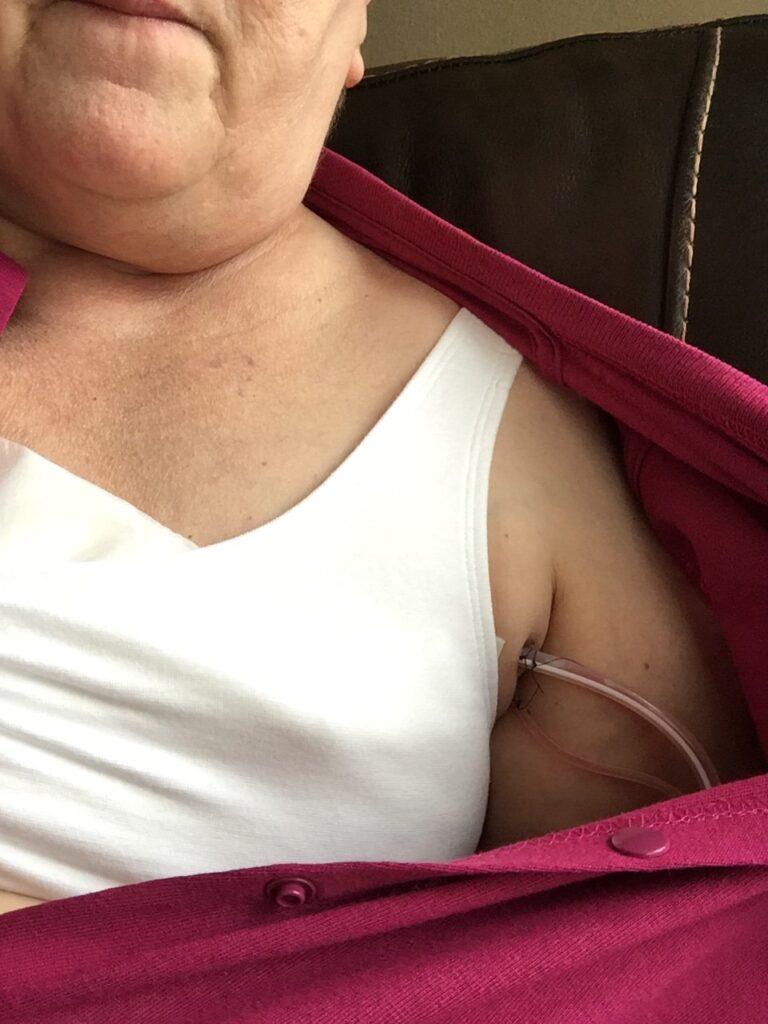 My mastectomy Recovery Story and the surgical drains
